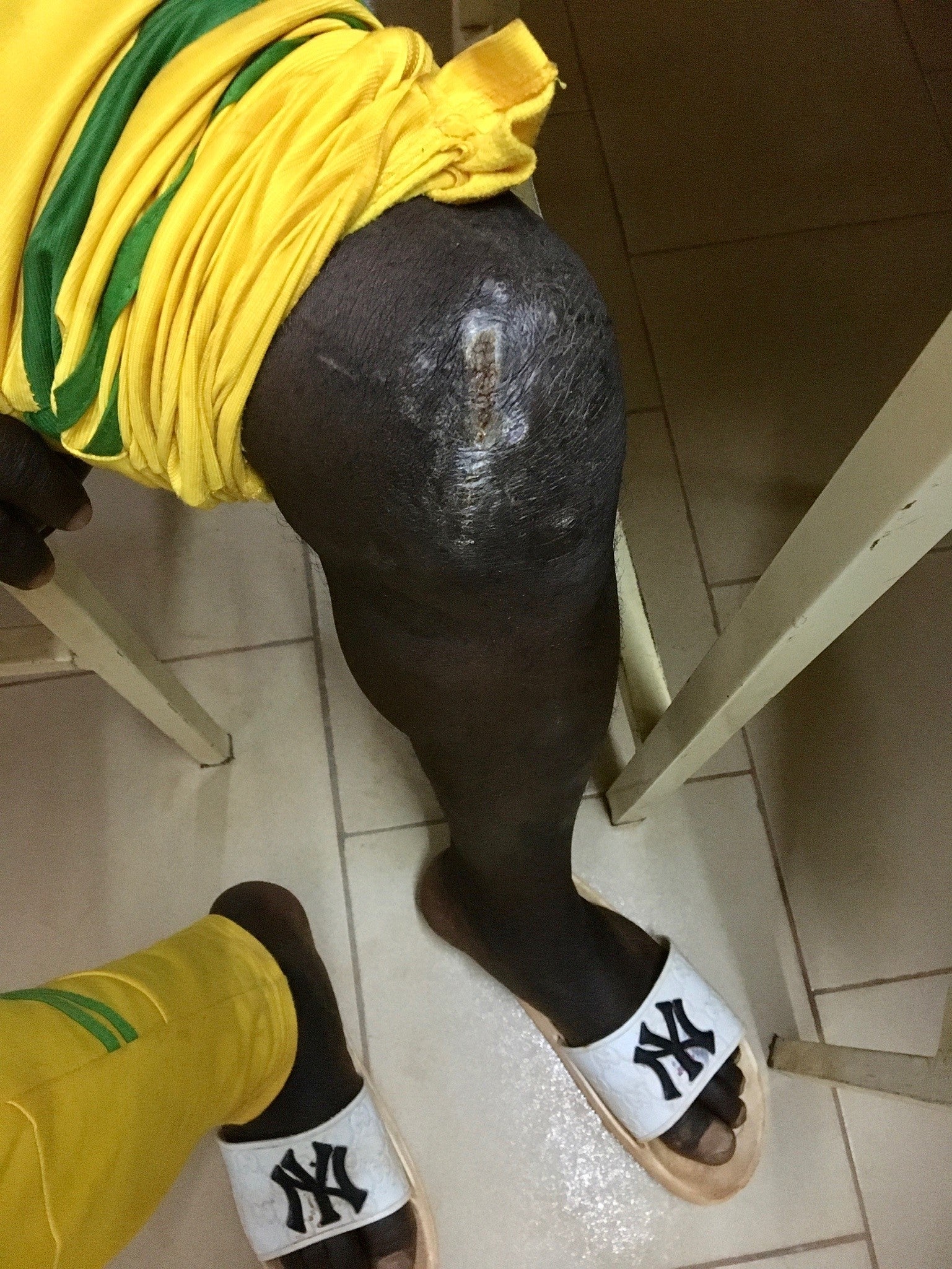 Wounds on a boy's knee