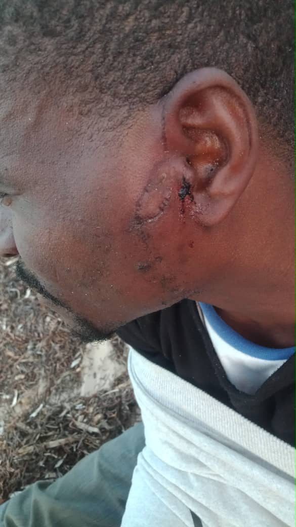 A man expelled to the Libyan border by Tunisian authorities on July 2, 2023 shows his injuries.