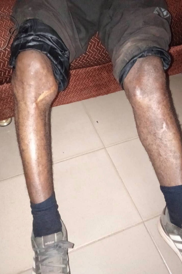 A 46-year-old Liberian man, Marco Gibson, shows his swollen knee