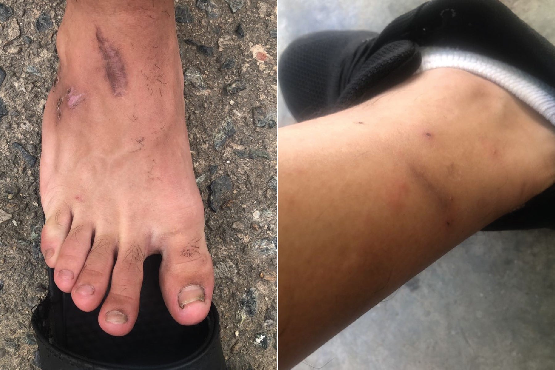 Photos provided by Wilson L., showing injuries on his leg and foot. 