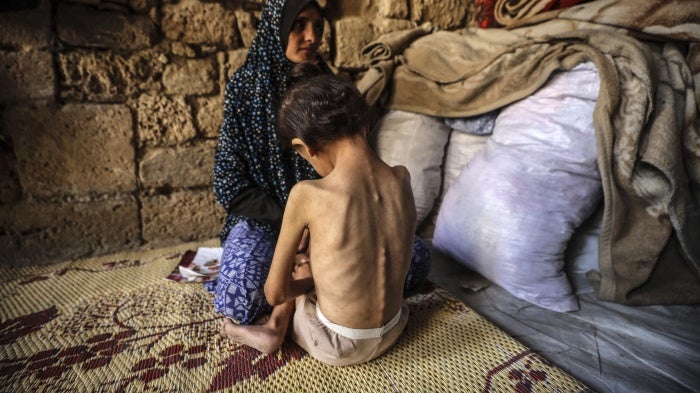 A woman consoles her 6-year-old daughter, who is malnourished, at a shelter in central Gaza City, on May 11, 2025.