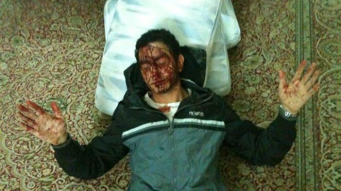 Sayed Ahmed al-Wadaei following his torture in 2011 by the Bahrain security forces.