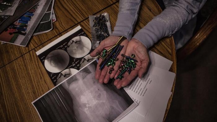 Maria Higginbotham, 57, holding screws and bolts removed from her back in a recent surgery above x-rays of her body.