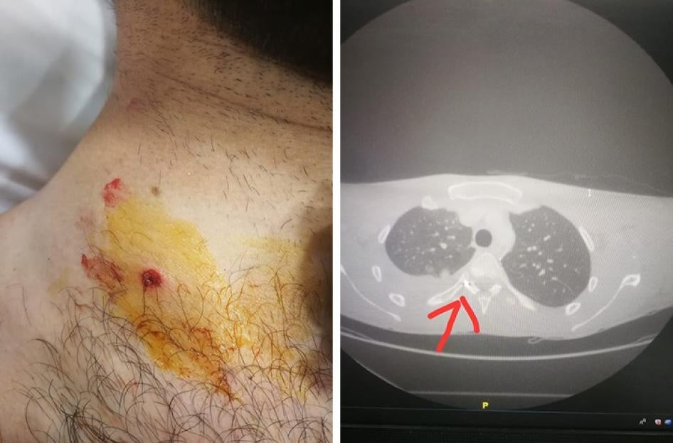 A metal pellet pierced through a protester’s neck, tore an artery, punctured the lung, and lodged in the spinal cord. 