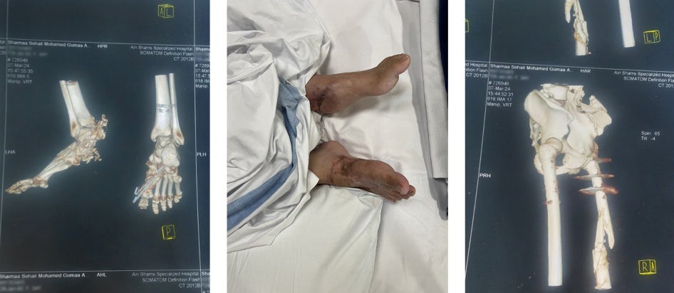 صورة مقطعية لقدمَيْ شيماء أبو جزر بعد الانفجار (يسار)، وقدمَيْ شيماء بعد 47 عملية جراحية، الدوحة، قطر (وسط)، وصورة مقطعية لشظايا معدنية في ساقها بعد الانفجار. 