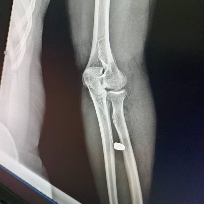  x-ray image of a 25-year-old man who was struck in the arm by a stray bullet