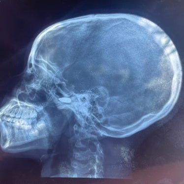x-ray image of a 15-year-old girl who was struck in the head by a stray bullet