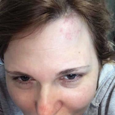 Journalist Elena Milashina, following an attack in Chechnya. 